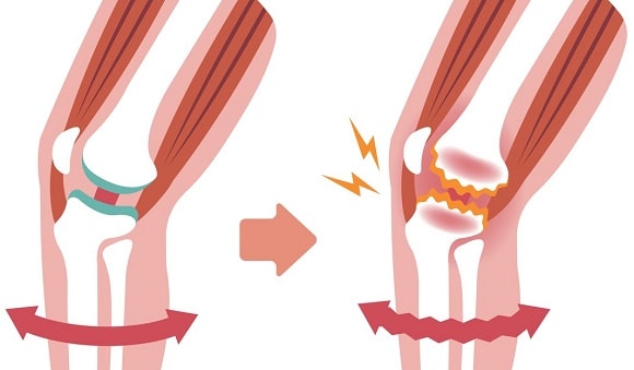 artrose-knie-oorzaken-symptomen-behandeling